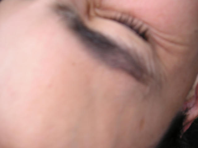 The results of being attacked with a camera.